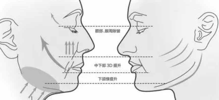 提拉童颜线雕和线雕的区别？是该公开真相的时候了！