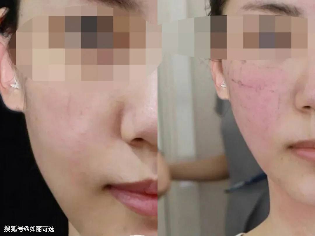 玛吉花3w做的热玛吉没给看二维码，很担心是假的，完全睡不着
