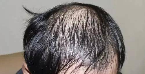 头皮易出油,会导致脂溢性脱发吗?