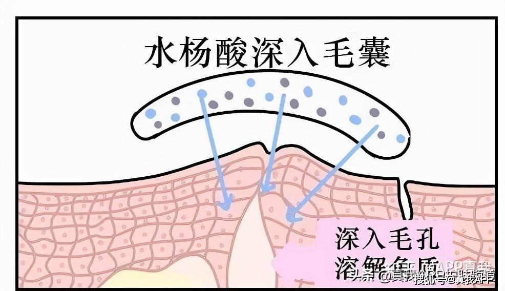 果酸换肤用有激素吗_果酸换肤有什么副作用吗_果酸换肤有用么