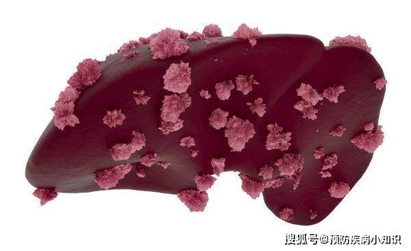 肝脏|肝病找上门时，身体会发出4个“求救信号”，务必要提高警惕