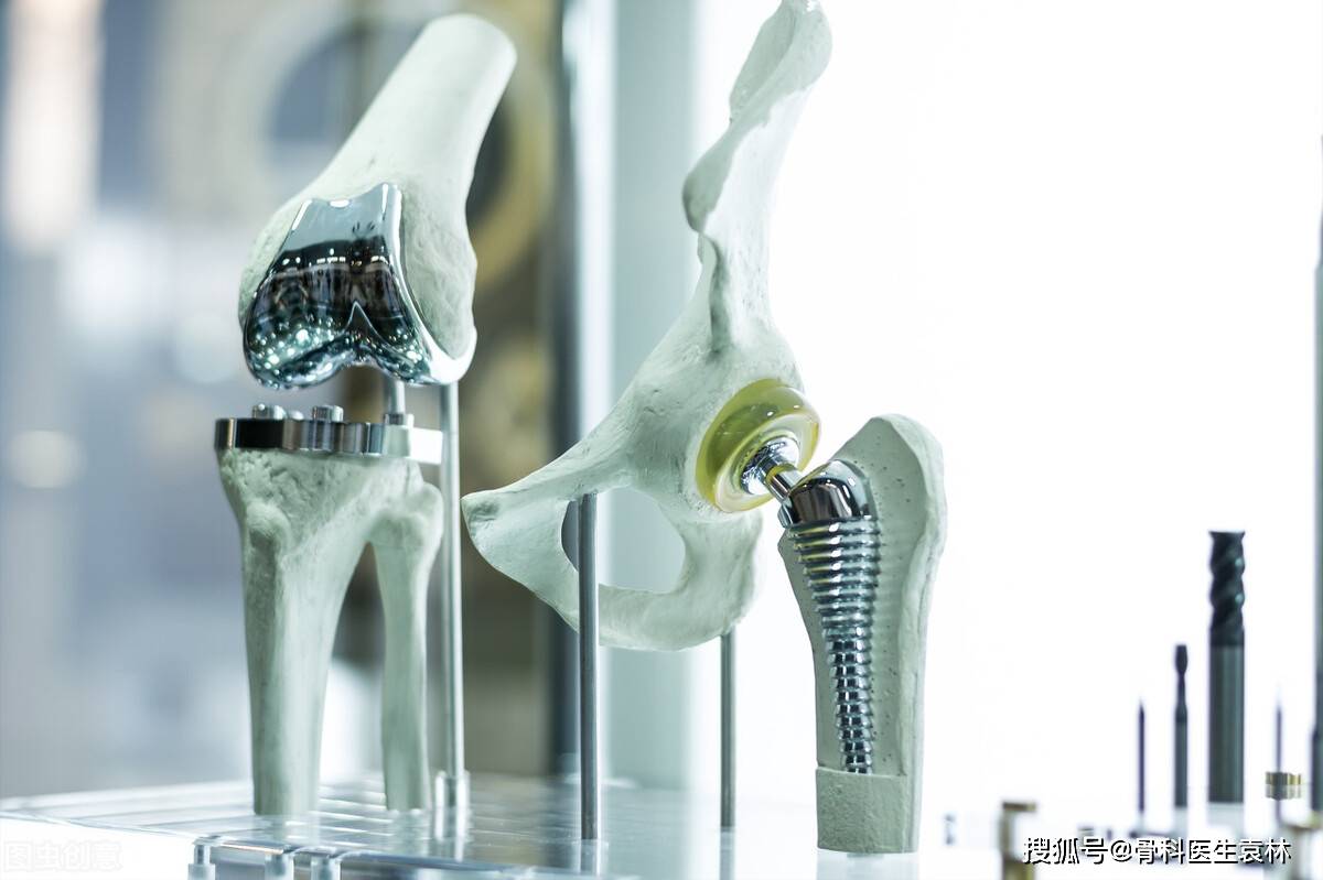 人工全膝关节假体通常由三部分组成:1,股骨假体:放置于股骨远端的股骨