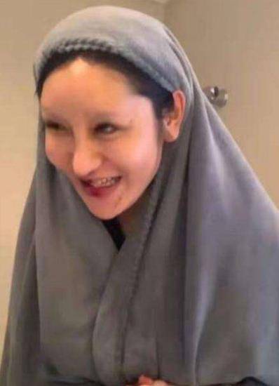 因为女网红沉迷整容却越整越难看，近照嘴巴肿成香肠嘴，承认整容失败