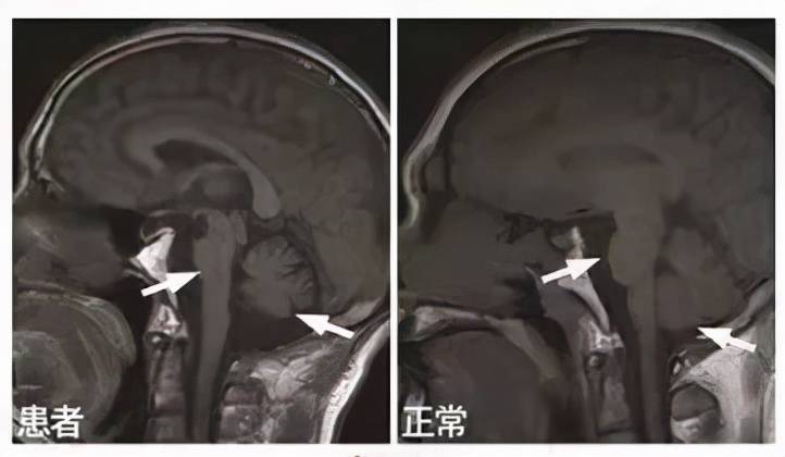 诊断|【小帕讲故事】诊断多系统萎缩1、2、3