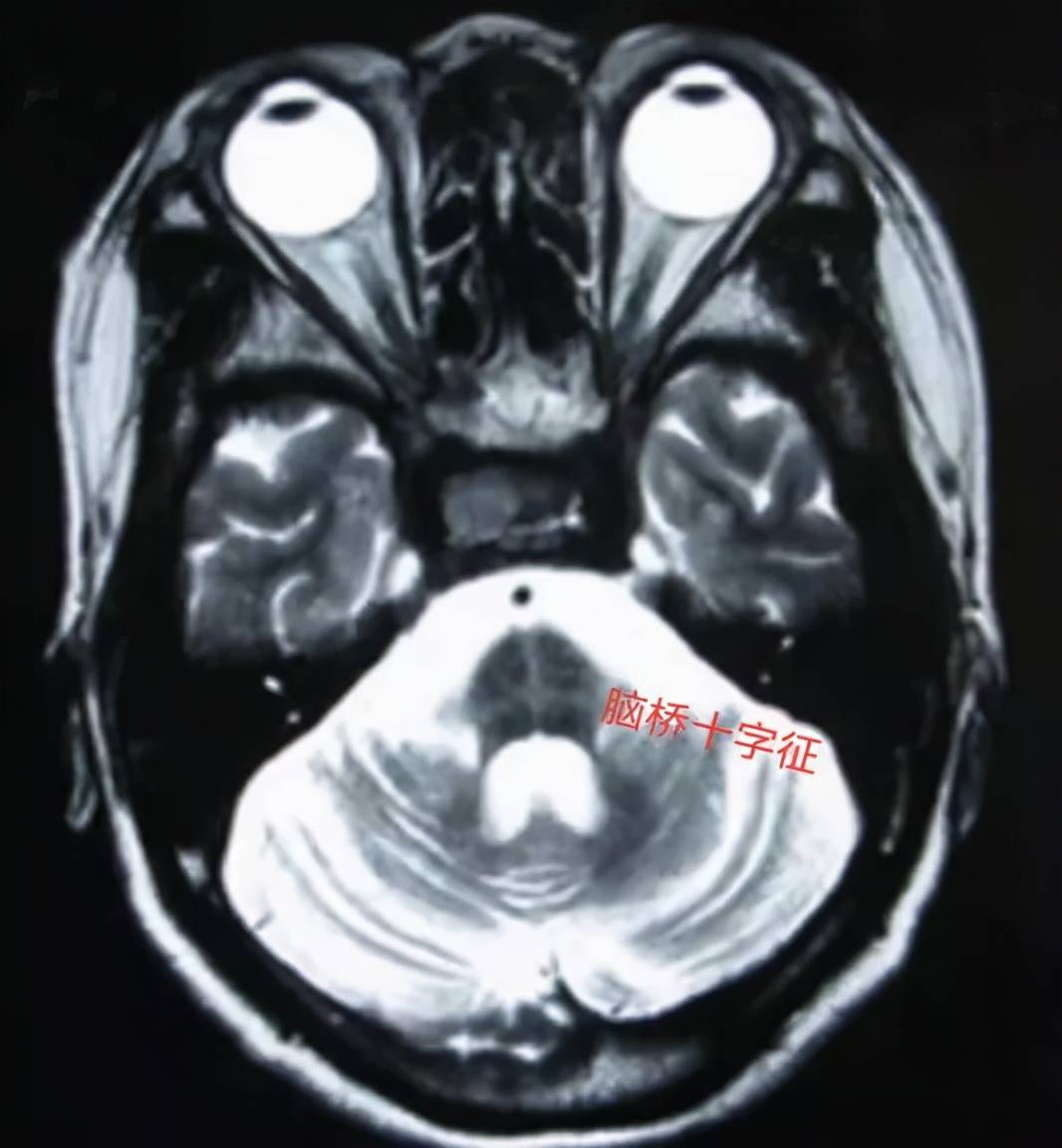 诊断|【小帕讲故事】诊断多系统萎缩1、2、3