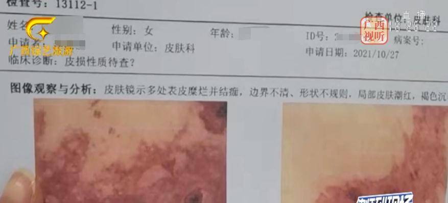 崩溃太崩溃！花上万元祛斑美容被灼伤，脸“烂”成这样