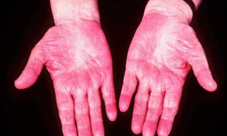 韩华东|35岁男子肝癌晚期,提醒大家:皮肤出现“蜘蛛痣”,及时检查