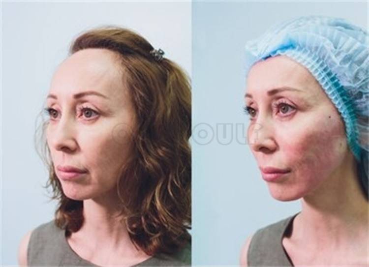 玛吉40岁做线雕还是热玛吉效果好、谁才是抗老扛把子？