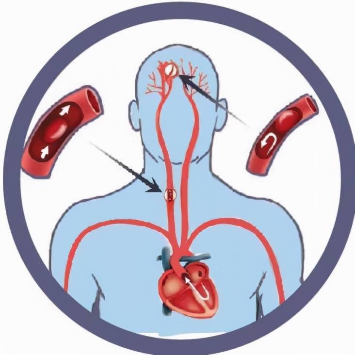 胡晓辉|西安市红会医院神经内科开展心源性卒中防治知识讲座