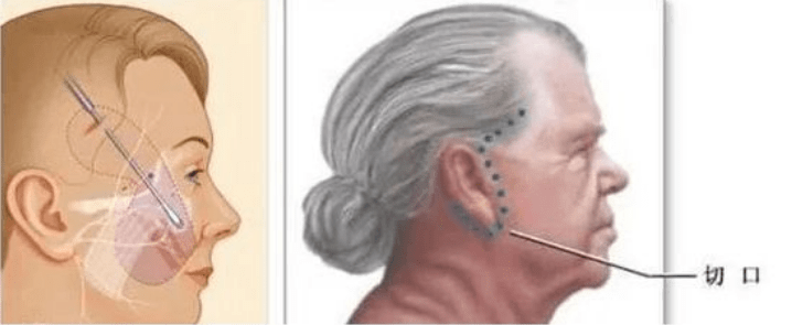 张力细解：50岁拉皮手术能维持几年？大拉皮手术的利弊出乎意料！