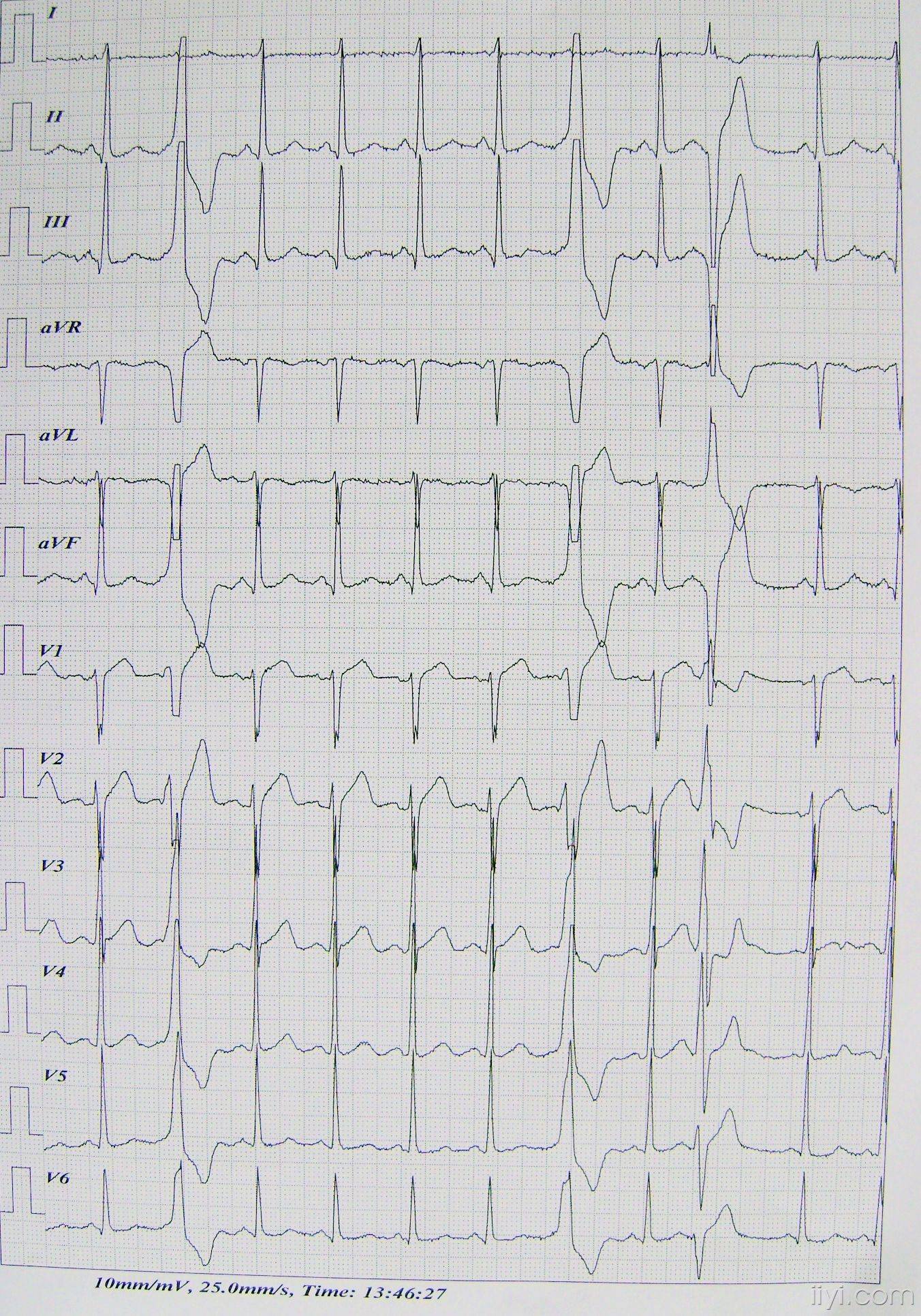 室上性早搏的心电图图片