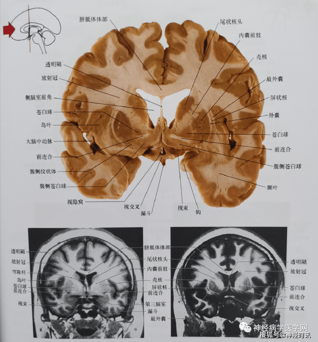 临床神经解剖图谱断层影像切片