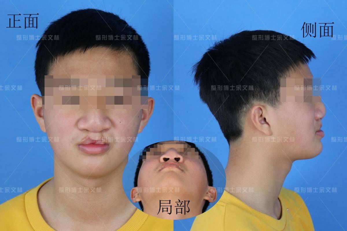 临床上,唇裂术后继发鼻畸形表现为鼻基底凹陷,鼻基底宽,鼻翼外脚外扩
