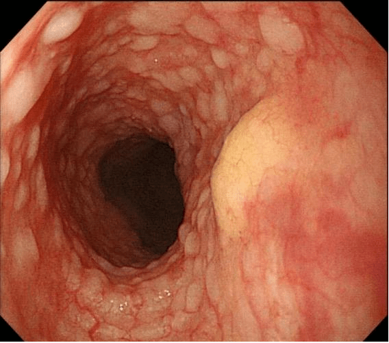 肠息肉图片肠癌图片
