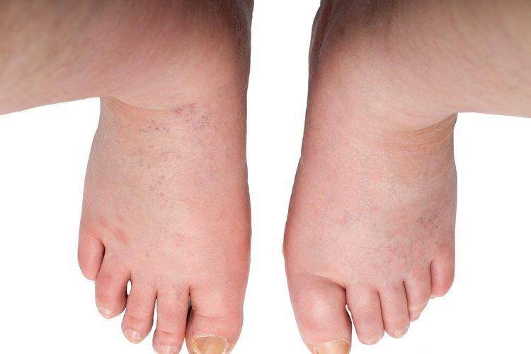 症状|不让糖尿病走向尿毒症，三个症状要提前“拦截”！