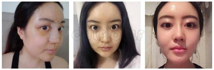 脸部脸部脂肪填充有风险吗、脂肪填充的危害有哪些、不敢看~