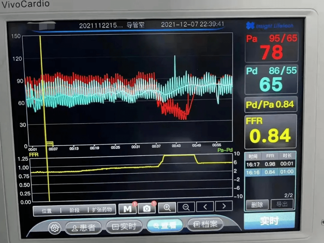检测|吕梁市人民医院成功开展腔内血流压力检测指导下的冠脉精准介入治疗