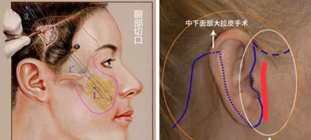 三个阶段纠结啊~40岁做拉皮会不会太早？剥离拉皮能保持多久？建议来了！