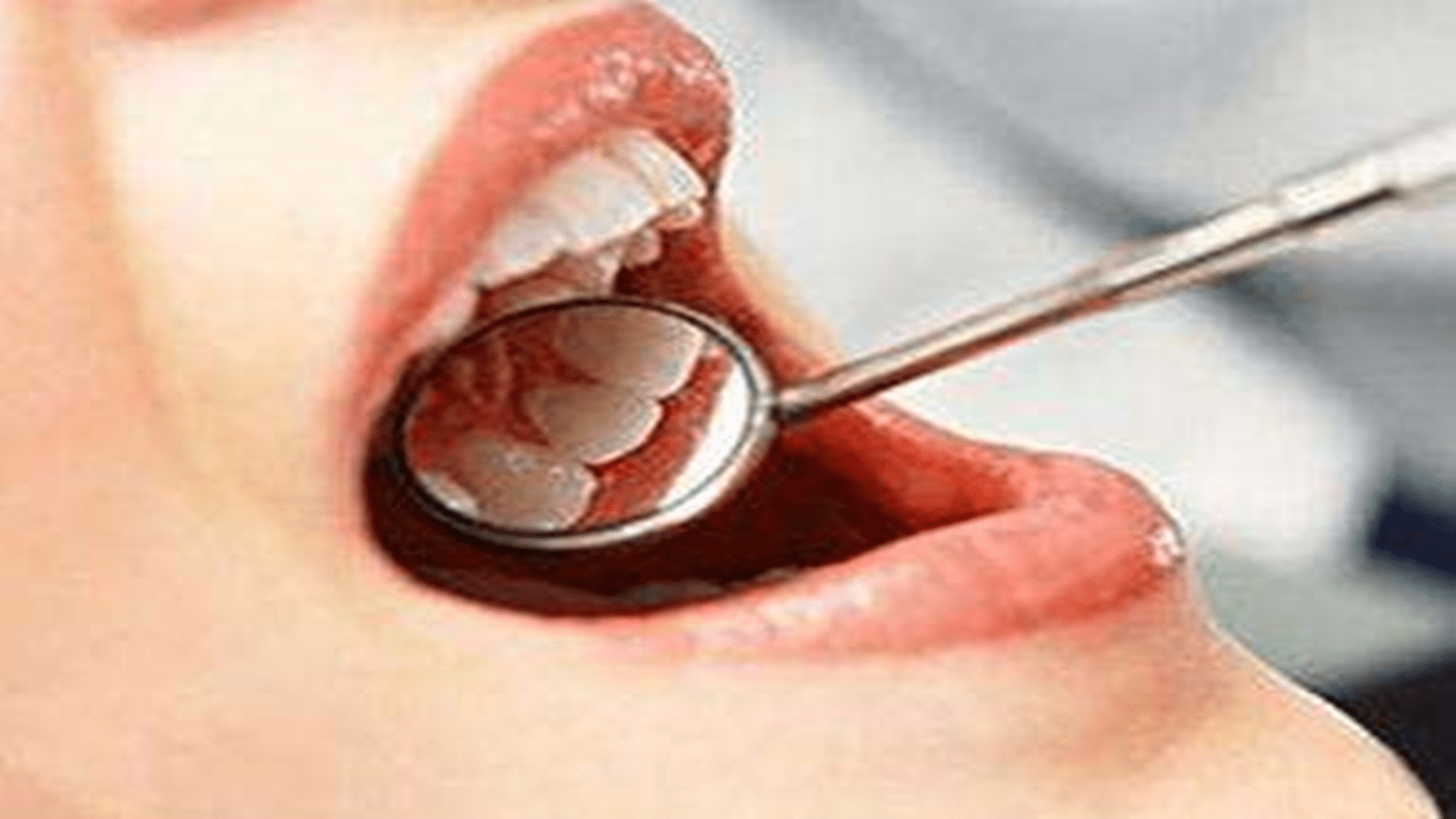 免疫力|口腔溃疡，不断复发，究竟是怎么回事？