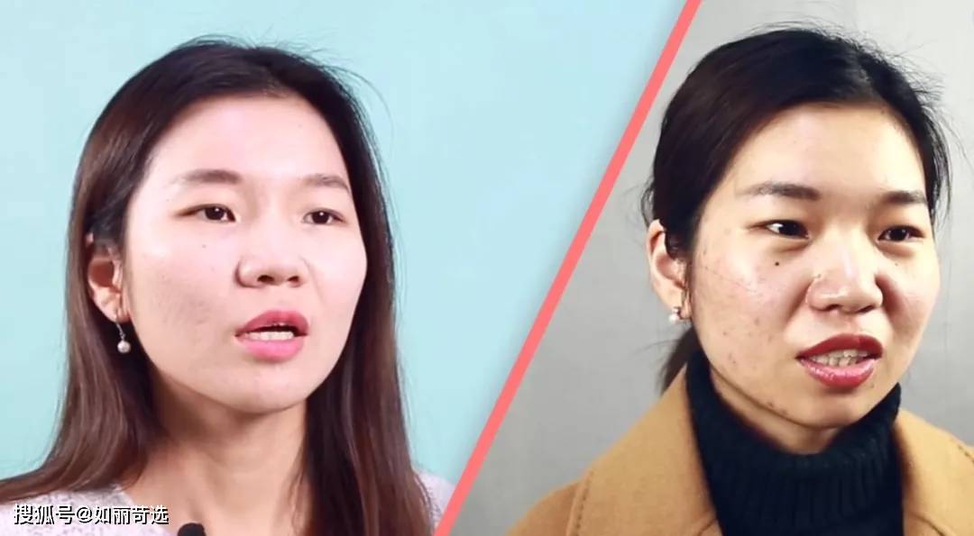 宋轶凸嘴无法修复的四种迹象，千万别中招