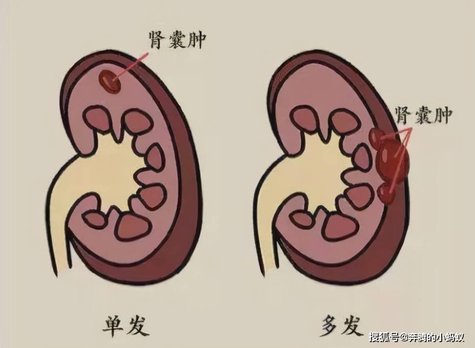 肝囊肿肾囊肿常见的治疗方法你了解几种