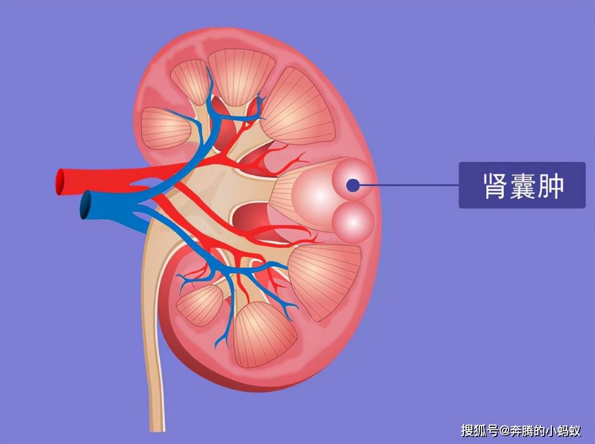 治疗|肾囊肿通过药物能控制住吗？