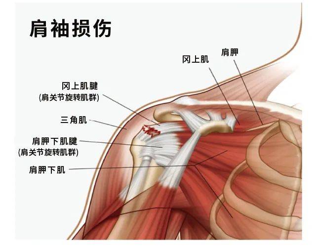 如何预防和改善网球运动带来的肩关节损伤?