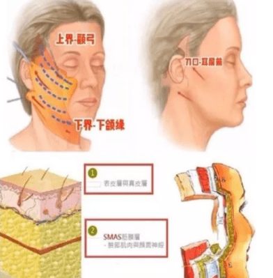 时间详细分析：大拉皮和小拉皮手术的区别，大拉皮手术15天照片！