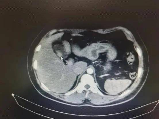 急性胆囊炎b超图片图片