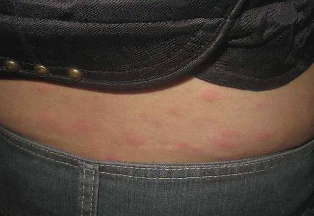 别不把荨麻疹当回事否则后果很严重