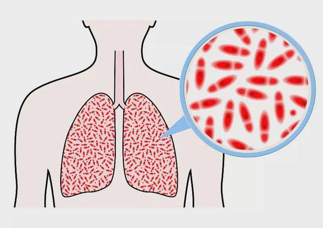 进行|简单三步，间质性肺炎不是问题！