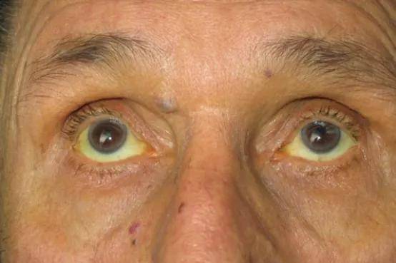 脑部若有4个"异样",或是肝癌"来访"_巩膜_肝脏_症状