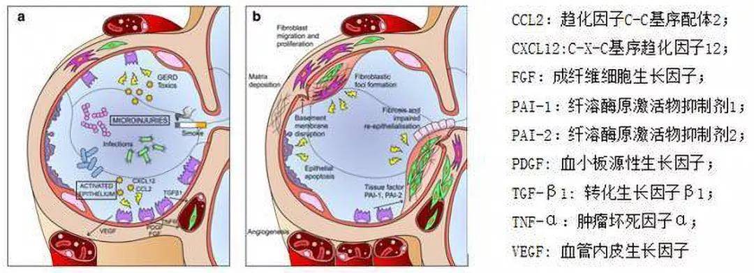 治疗|一文读懂:间充质干细胞治疗慢阻肺的原理