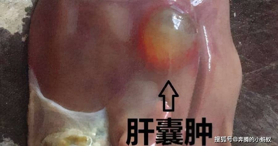 肝囊肿会引起肝功能异常吗?_患者_肝脏_症状