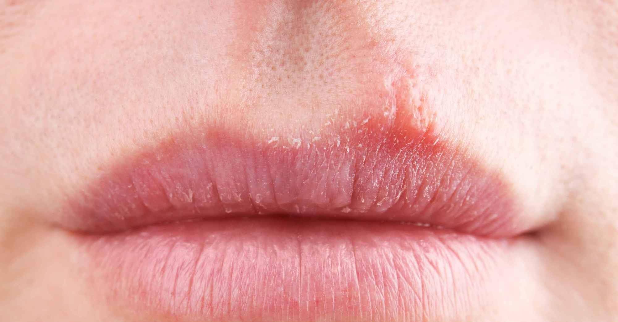 肝脏|患上肝病，脸上先知，提醒，出现这5个体征，是肝病的先兆