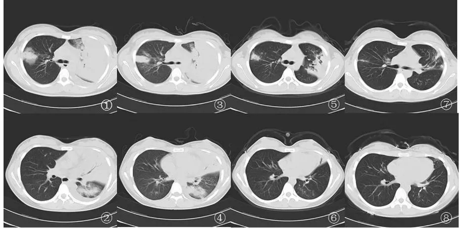 第1天胸部ct示雙肺多發斑片樣滲出影,左上肺實變,內可見支氣管充氣徵