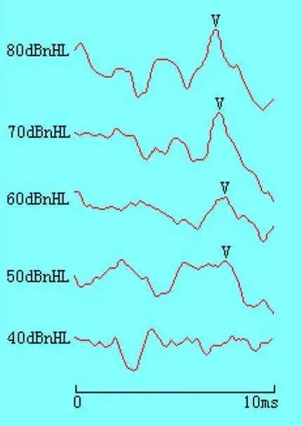 脑干诱发电位的测试结果可以等同于纯音测试吗