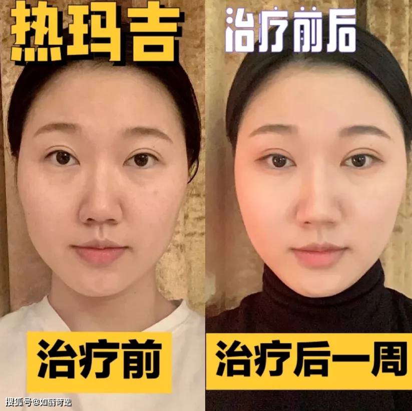 玛吉明星都在做的热玛吉？不推荐你做，理由只有一个（不是贵）