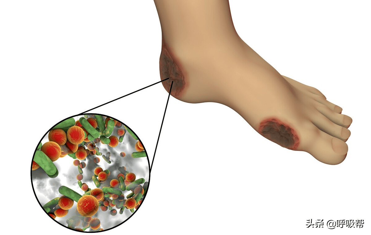 血管|一文浅谈糖尿病足的评估与治疗