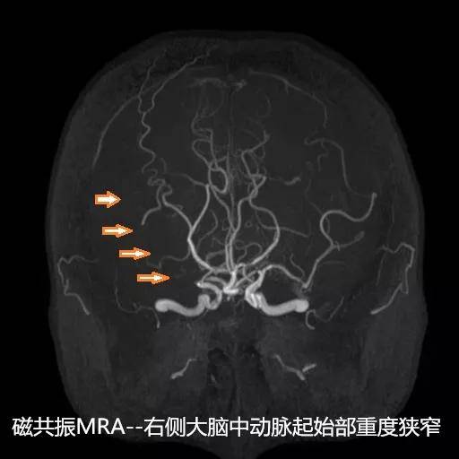 科普急性缺血性腦卒中影像檢查要先行