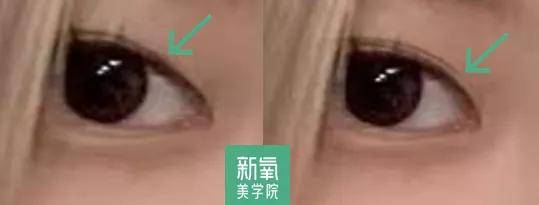 度数很多人都混淆了眯眯眼和小眼睛的区别