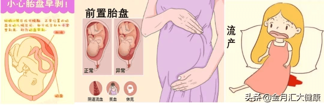 泡沫痰|疫情期间，孕妇出现哪些孕期异常情况必须就诊？