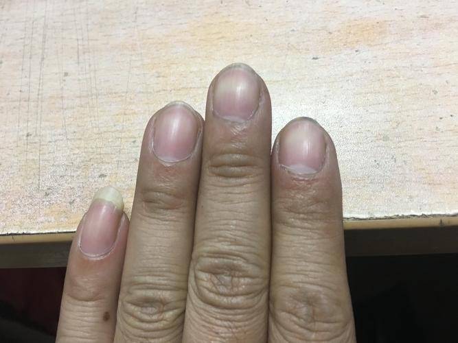 手若有这3种迹象,或是癌细胞"到访"_癌症_免疫_手指头