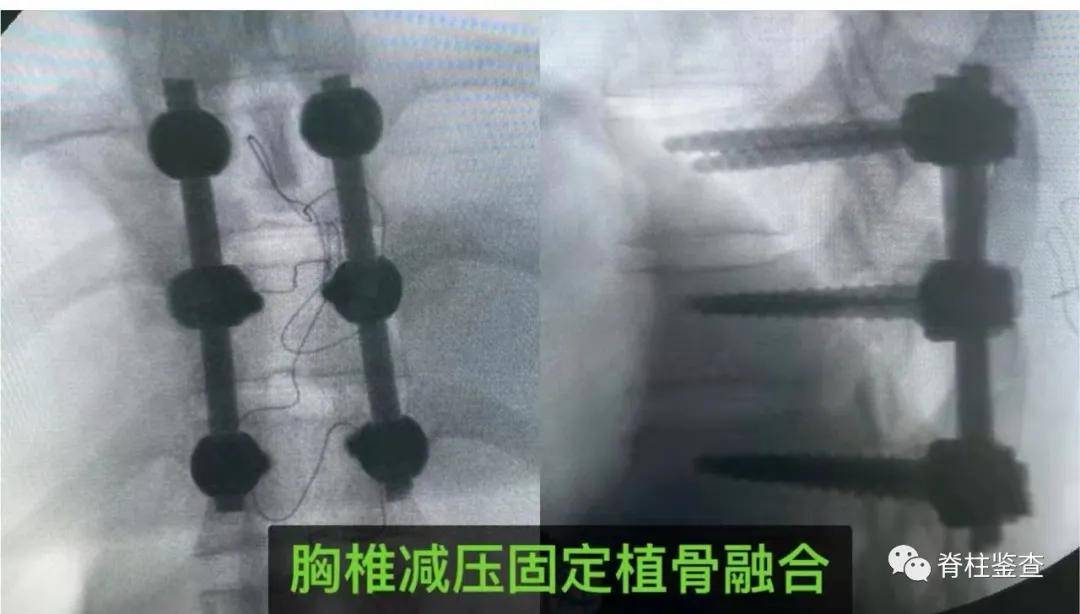 脊柱|多学科MDT急诊救治脊柱结核性截瘫+慢性肾功能衰竭血液透析患者