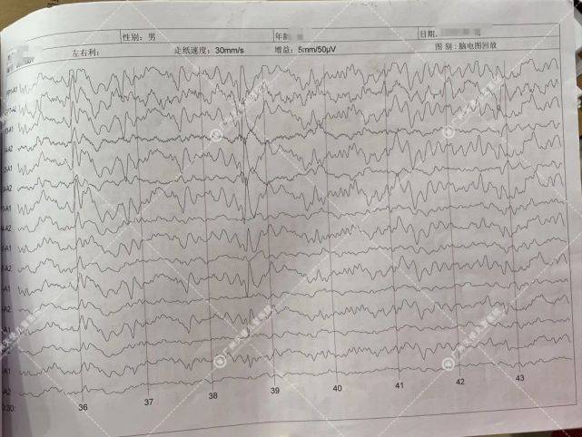 脑电图报告单图片