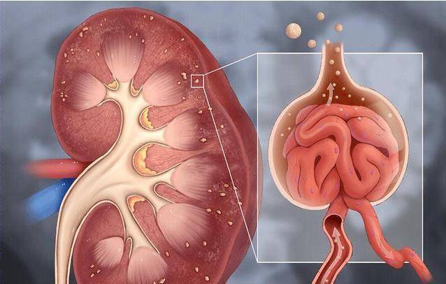 肾脏|尿毒症是怎么患上的？医生提醒：生活中，建议远离3个坏习惯