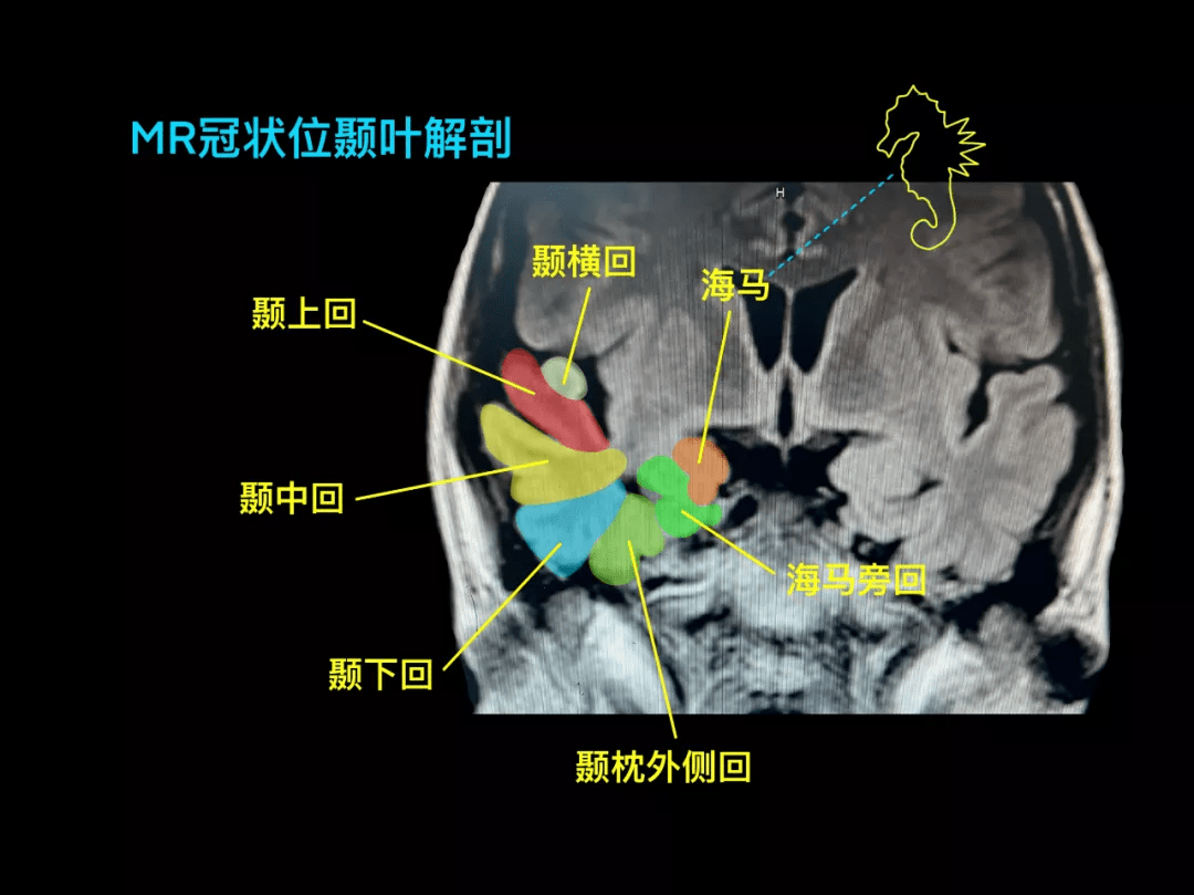 颅脑海马解剖图图片