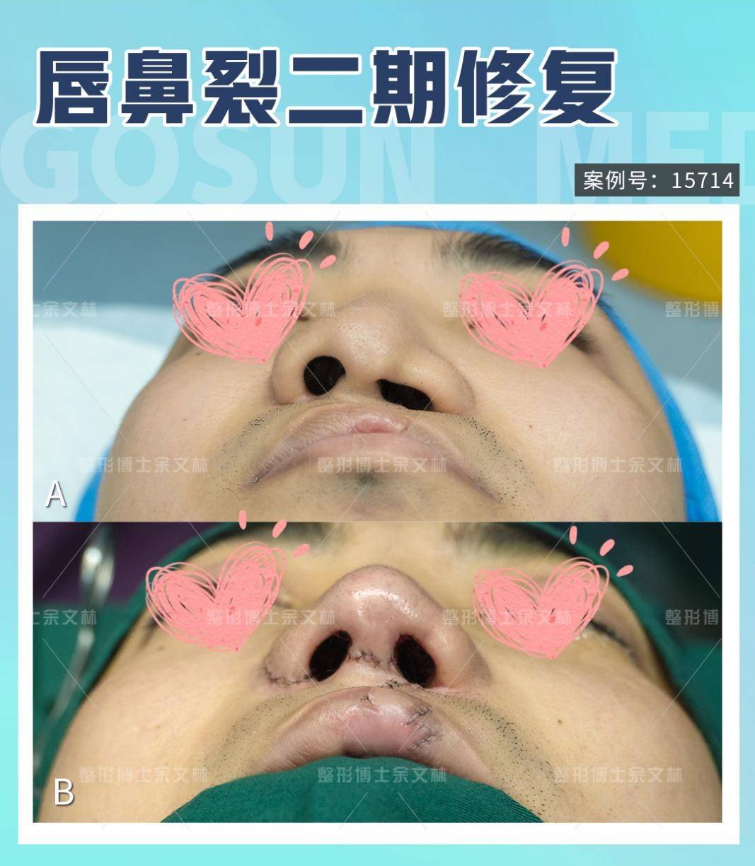 唇裂继发鼻畸形修复后,鼻孔能对称吗?_软骨_鼻翼_鼻中隔