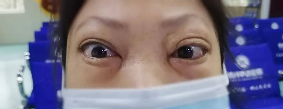 嚴重甲亢突眼畏光視力模糊奔走多家醫院無果