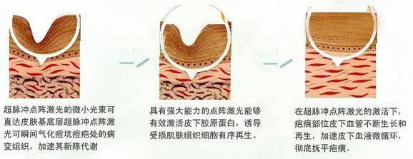 果酸女孩挤痘痘诱发败血症?祛痘千万不能做的那些事儿！纯干货祛痘指南分享!
